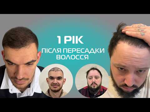 Методы пересадки волос DHI и FUE: как проходит процедура