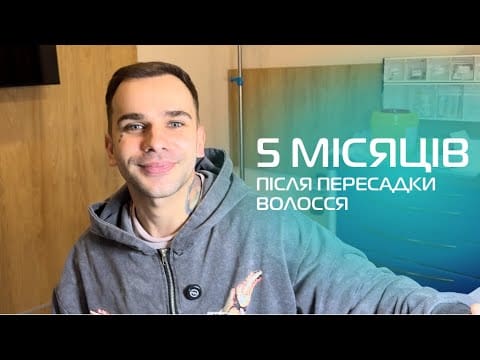 Hair Transplant Results After 5 Months: What to Expect