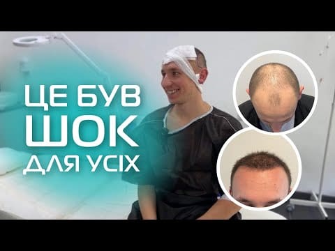 От выбритой головы к новой прическе: реальный опыт пересадки волос